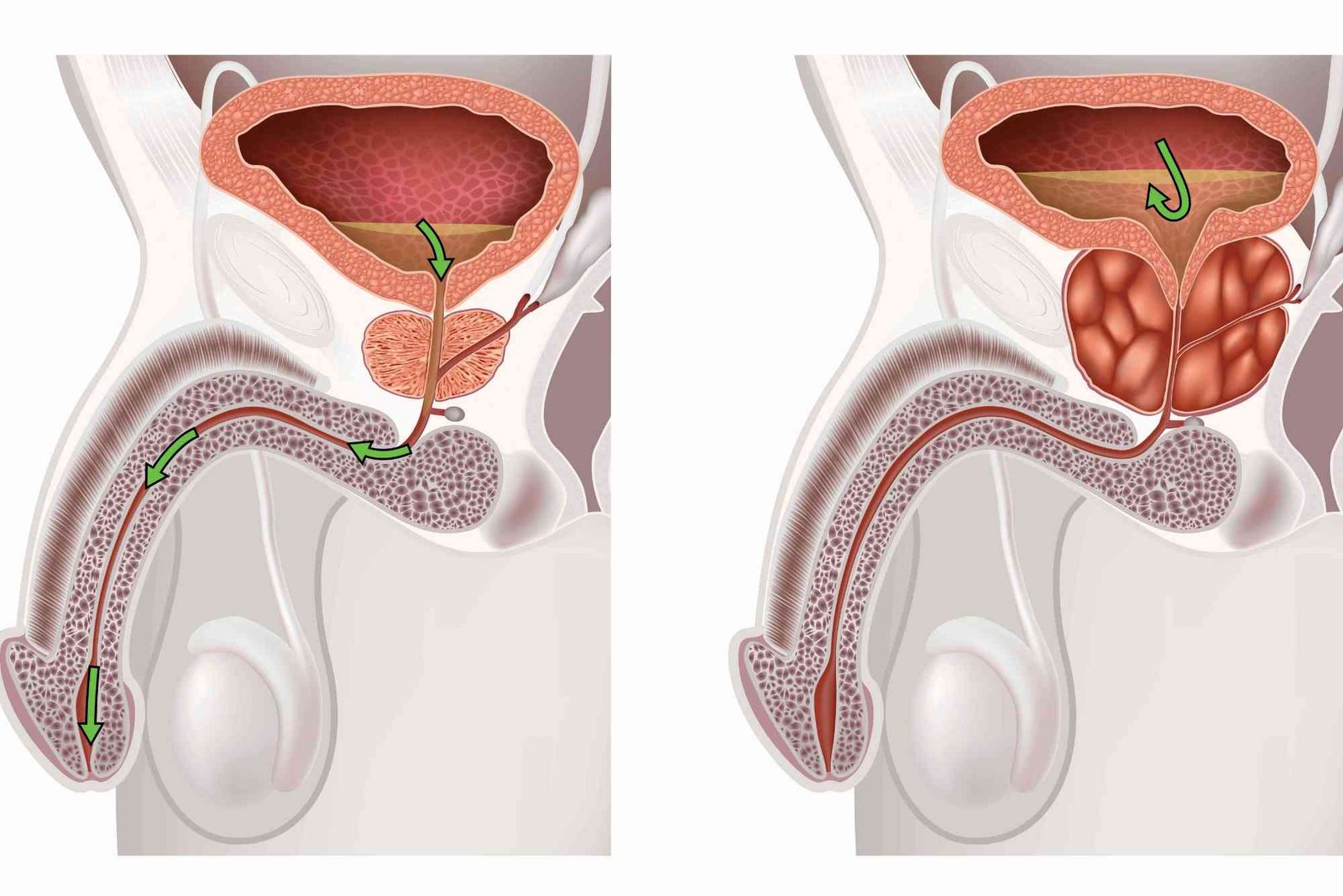 Practical Tips: Can Lifestyle Changes Improve Prostatic Hyperplasia Symptoms