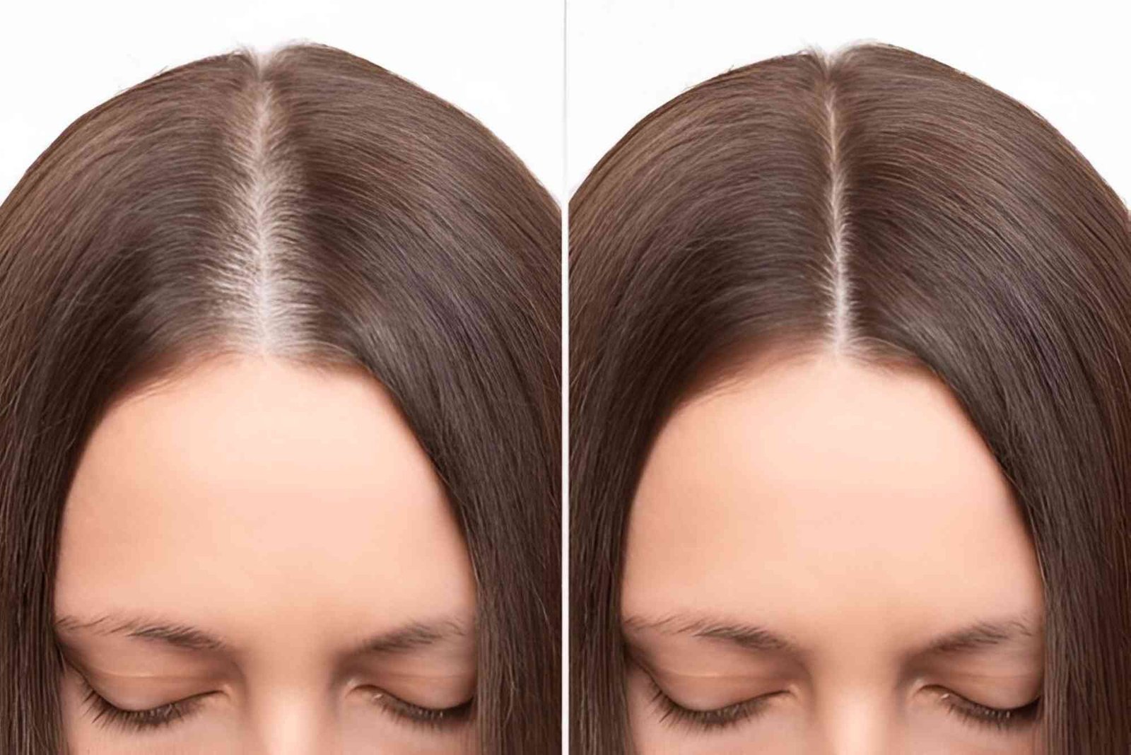Hair Transplant Turkey